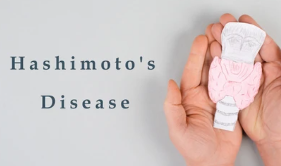 Hashimoto Disease: Menguak Misteri Gangguan Autoimun pada Tiroid
