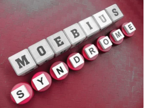 Mengenal Lebih Dalam si Penyakit Genetik Langka, Mobius Syndrome