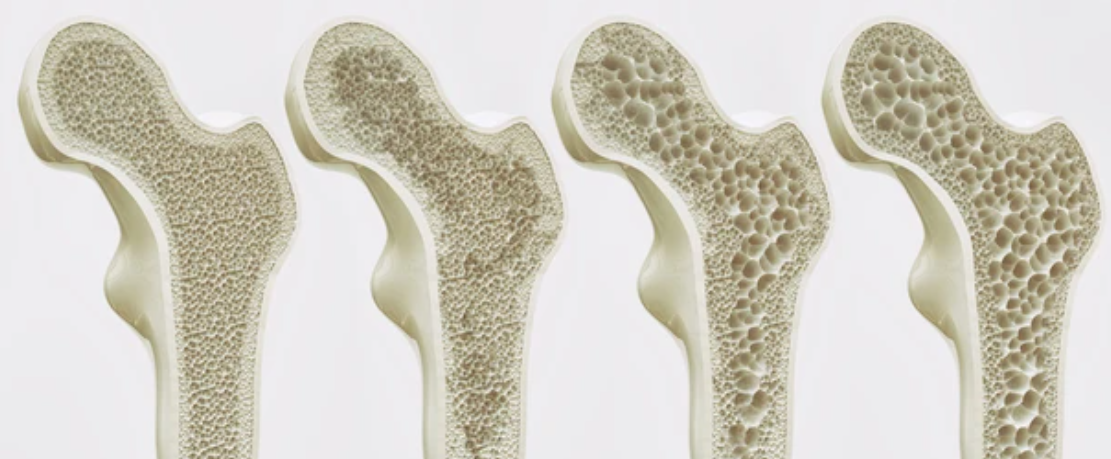 Osteoporosis: “Si Silent Killer” yang Perlu Anda Ketahui!