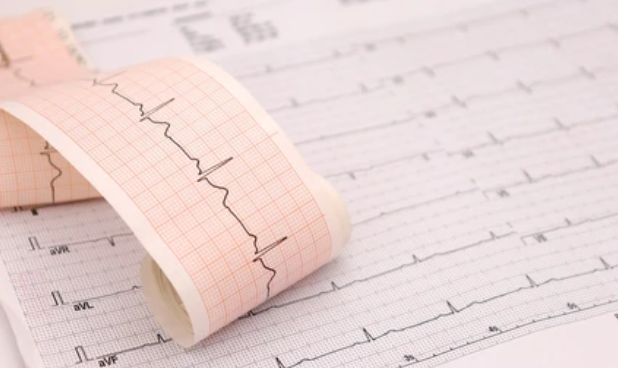 Pentingnya Pemeriksaan EKG dalam Medical Check-Up: Deteksi Dini Kelainan Irama Jantung