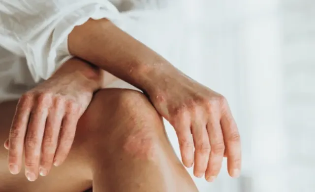 Psoriasis: Si Merah Bandel yang Menyiksa